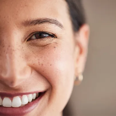 metade do rosto de uma mulher com pintas sorrindo 